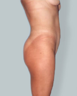 Tummy tuck with liposuction of the mons pubis, and a pubic lift 