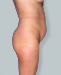 Mons Pubis Liposuction - Procedure for Lower Abdomen Area