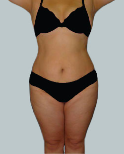 cs1_liposuction_Face_after-img