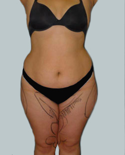 Liposuction Melbourne Procedures [2024 Before + After Pics]