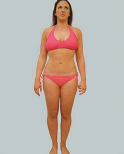 cs1_liposuction_Face_after-img