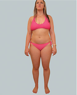 cs1_liposuction_face_before-img