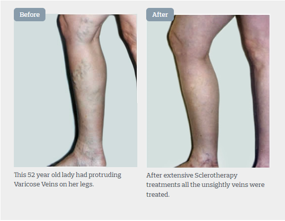 No Surgery; No Downtime: Sclerotherapy for Treating Varicose and