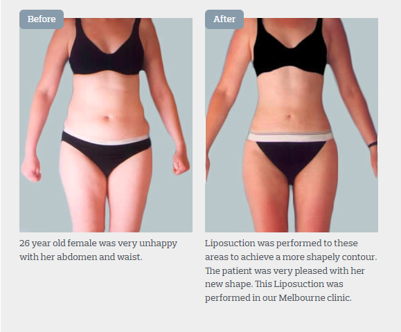 Liposuction vs Weight Loss Surgery: What Should You Choose?