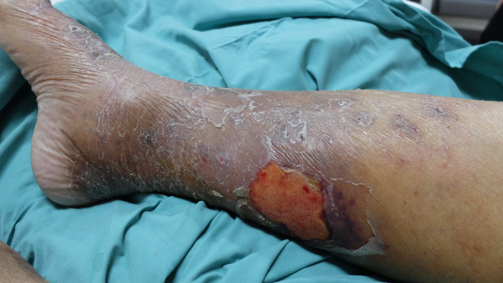 chronic-venous-insufficiency