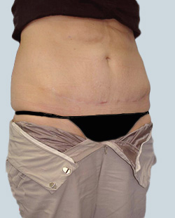 cs1_liposuction_Face_after-img