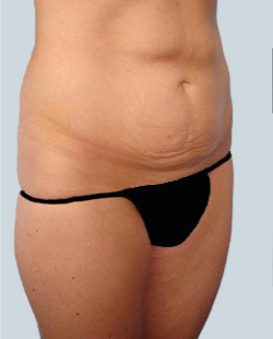 cs1_liposuction_face_before-img