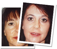 Laser Cosmetic Surgery