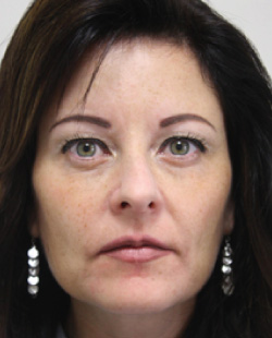 cs1_liposuction_Face_after-img