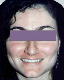 cs1_liposuction_Face_after-img