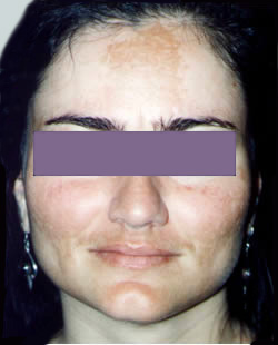 cs1_liposuction_face_before-img