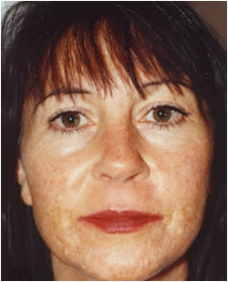 cs1_liposuction_face_before-img