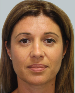 cs1_liposuction_face_before-img