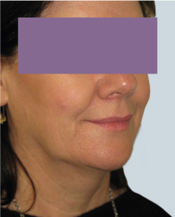 cs1_liposuction_Face_after-img