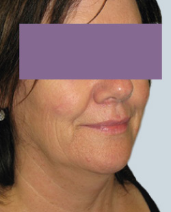 cs1_liposuction_face_before-img