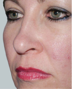 cs1_liposuction_Face_after-img