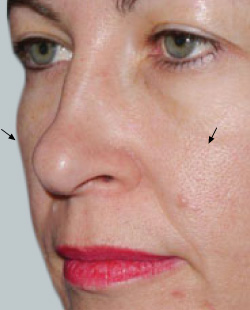 cs1_liposuction_face_before-img