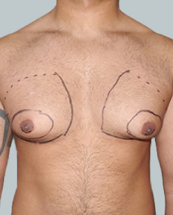 cs1_liposuction_face_before-img