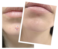 Mole Removal Case Study