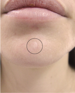 cs1_liposuction_Face_after-img