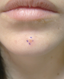 cs1_liposuction_face_before-img