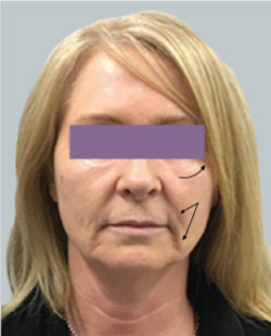 cs1_liposuction_face_before-img