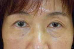 cs1_liposuction_Face_after-img