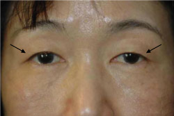 cs1_liposuction_face_before-img