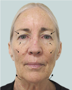 cs1_liposuction_face_before-img