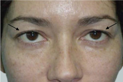 cs1_liposuction_face_before-img