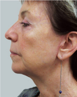 cs1_liposuction_Face_after-img