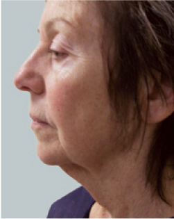 cs1_liposuction_face_before-img