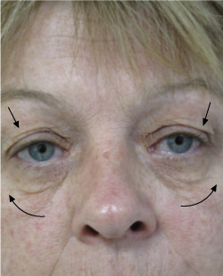 cs1_liposuction_face_before-img