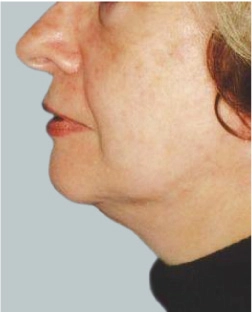 cs1_liposuction_Face_after-img