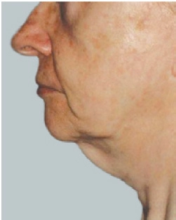 cs1_liposuction_face_before-img