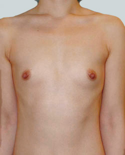 cs1_liposuction_face_before-img