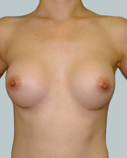 cs1_liposuction_Face_after-img