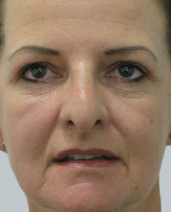 cs1_liposuction_Face_after-img