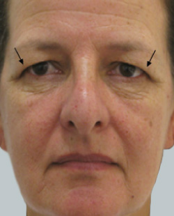 cs1_liposuction_face_before-img