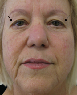 cs1_liposuction_face_before-img