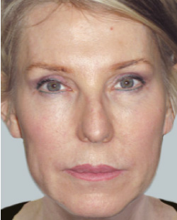 cs1_liposuction_Face_after-img