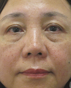 cs1_liposuction_Face_after-img