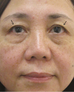 cs1_liposuction_face_before-img