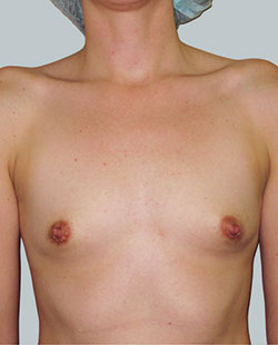 cs1_liposuction_face_before-img