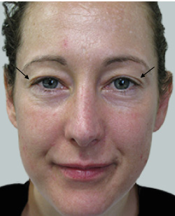 cs1_liposuction_face_before-img