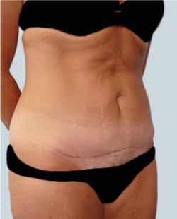 cs1_liposuction_Face_after-img