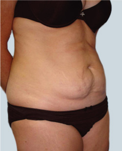 cs1_liposuction_face_before-img