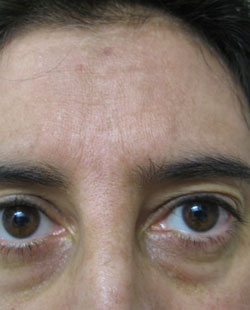 cs1_liposuction_Face_after-img