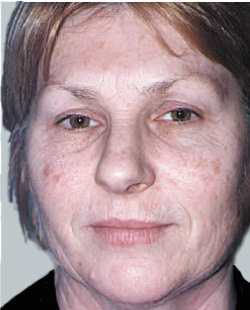 cs1_liposuction_face_before-img