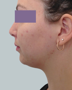 cs1_liposuction_Face_after-img